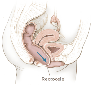 Rectocèle : symptômes, diagnostic et traitement | Dr Yannick Nijs