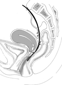 rectocele behandeling tekening